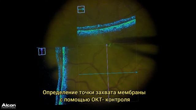 Эпиретинальная мембрана - удаление без витрэктомии с интра-ОКТ