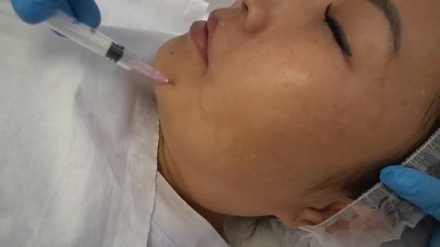 Наппаж - Техника выполнения мезотерапии