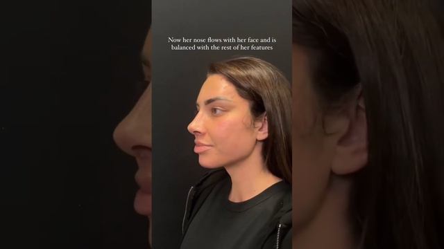 Leila Hormozi 1 week after Designer Rhinoplasty®