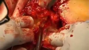 Резекция молочной железы resection of the breastT1N1M0