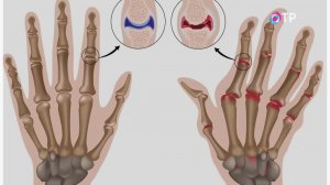 Ревматоидный артрит. Как предотвратить заболевание?