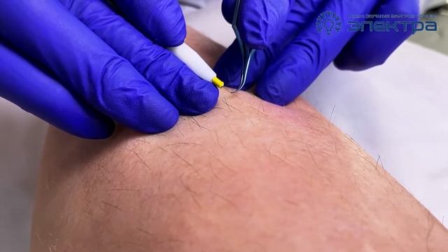 Обзор пинцетов для электроэпиляции / Виды пинцетов / Пинцет для электролога