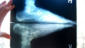 Диагностика плоскостопия