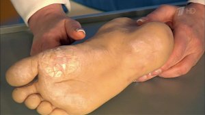 Натоптыши как симптом диабета. Что скрывают сухие ...и. Жить здорово! Фрагмент выпуска от 11.12.2015