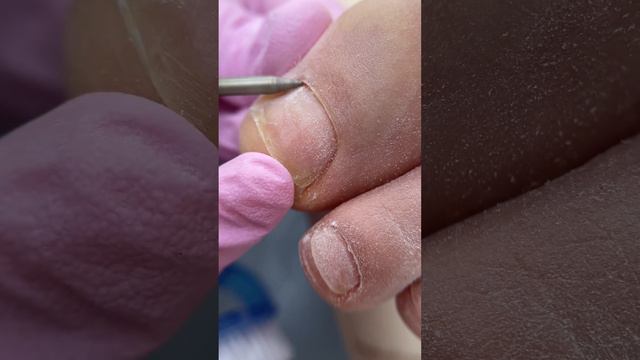 Отдавила ногти узкой обувью, покрытие плёнками. #nailart #онихолизис #подология #курсыпедикюра