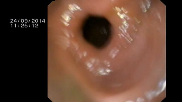 Метастаз (імплантаційний) раку прямої кишки в передню черевну стінку після резекції прямої кишки смотреть онлайн