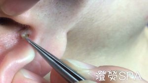 清粉刺耳朵粉刺