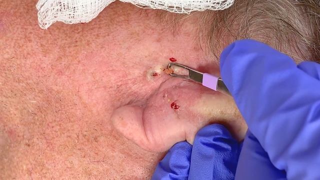 Extraction Satisfaction Blackhead Removal  CONTOUR DERMATOLOGY