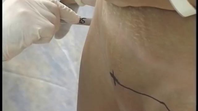 разметка перед пластикой смотреть онлайн