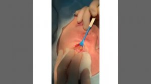 Пластика нижних век в процессе