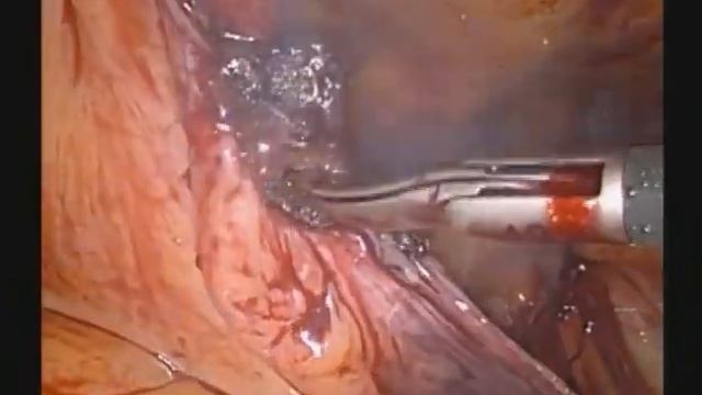 TAPP hernia repair смотреть онлайн