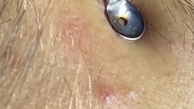 Satifying videos for Relaxation| чёрные точки | прыщи выдавливание| акне |угри смотреть онлайн