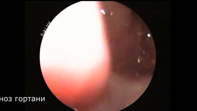 Флегмонозный ларингит смотреть онлайн