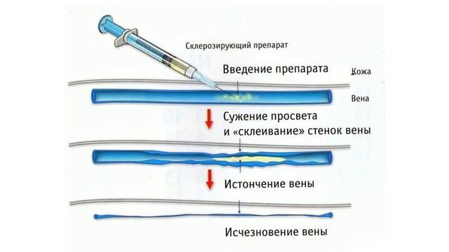 Флебосклерозирование в Ника Спринг