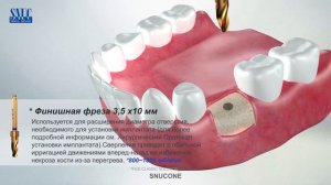 SNUCONE Dental Implant
