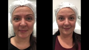 Ботокс лицо. До и после. Ботулинотерапия