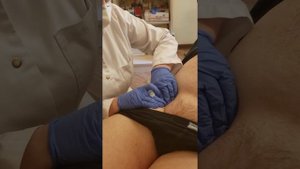 НЕВРИТ БЕДРЕННОГО НЕРВА