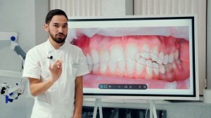 Виниры или брекеты?