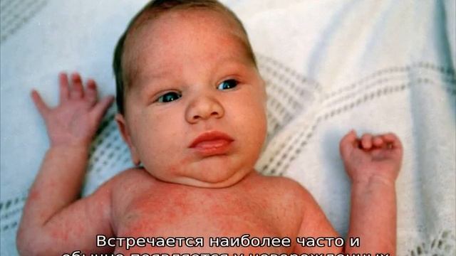 Как отличить потницу от аллергии у грудничка