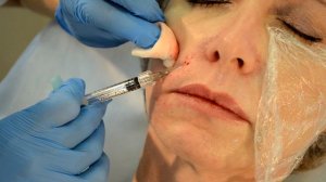 Моделирование, коррекция овала лица, убрать подбородок, носогубные складки и морщины