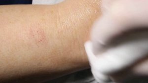 постинъекционный флебит