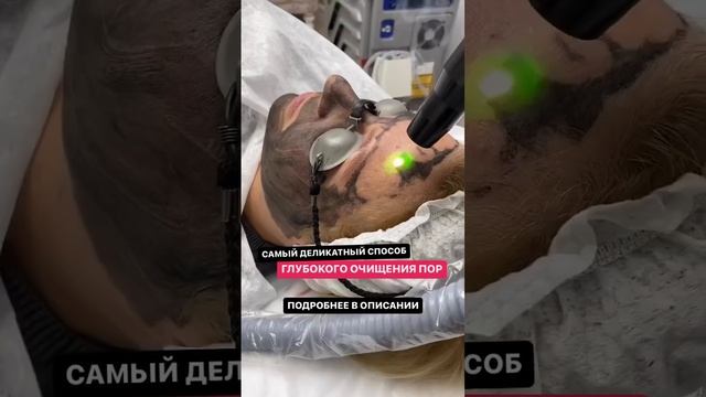 Карбоновый пилинг смотреть онлайн