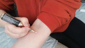 Удаление келоидных шрамов жидким азотом.