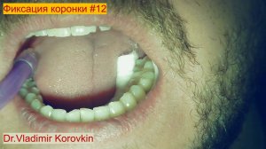 Фиксвация ZR Pretau 36d . Кейс #12..