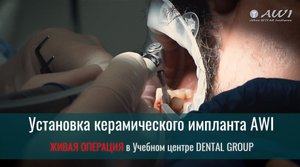 Живая операция: установка керамического импланта. Видео для медицины