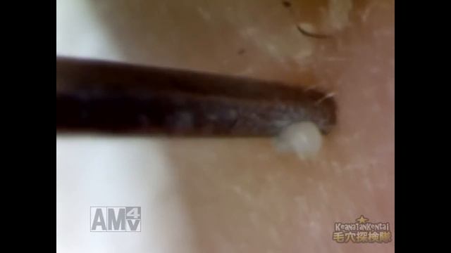 #10 Continuous Removal of Blackheads Close up - Squeezing Blackheads смотреть онлайн