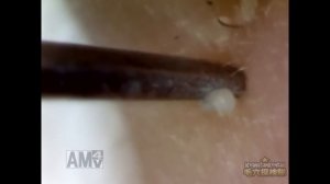 #10 Continuous Removal of Blackheads Close up - Squeezing Blackheads