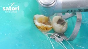 Препарирование кариозной полости |  стоматология в Самаре | odontologia