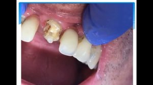 Как вырастить зуб за один час