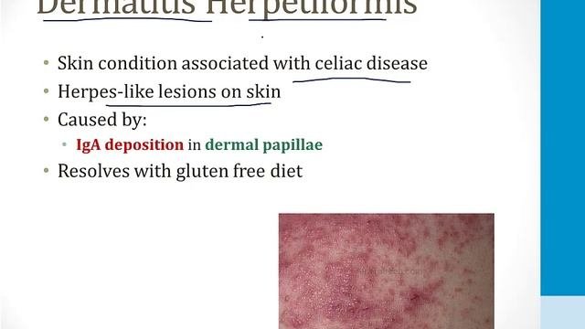 Гастроэнтерология USMLE - 3. Клиническая гастроэнтерология - 9.Мальабсорбция
