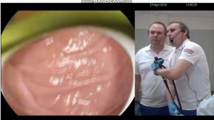 Визуализация большого дуоденального сосочка