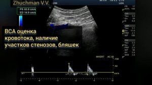 УЗИ сосудов шеи, основные измерения
