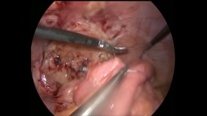 Клинический случай пациента Ч  Лапароскопическое закрытие илеостомы