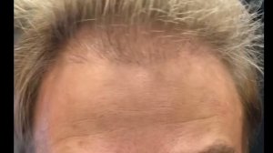 7 месяцев после пересадки волос