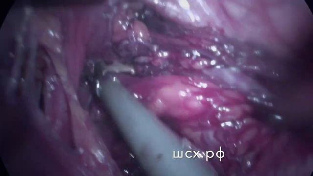 Рефундопликация после пластики Черноусова смотреть онлайн