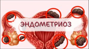 ЭНДОМЕТРИОЗ: ВЗГЛЯД ИЗ АСТРАЛА