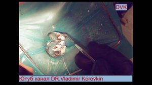 Установка круговой матрицы Supermat Kerr . 46 зуб 2 класс МОД.