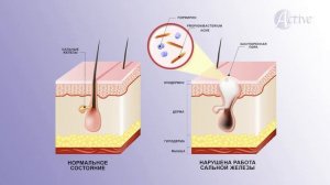 Удаление акне. Что такое акне. Стоимость удаления акне.
