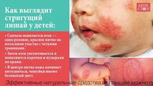 Стригущий лишай у детей – как он выглядит Смотрите в этом видео