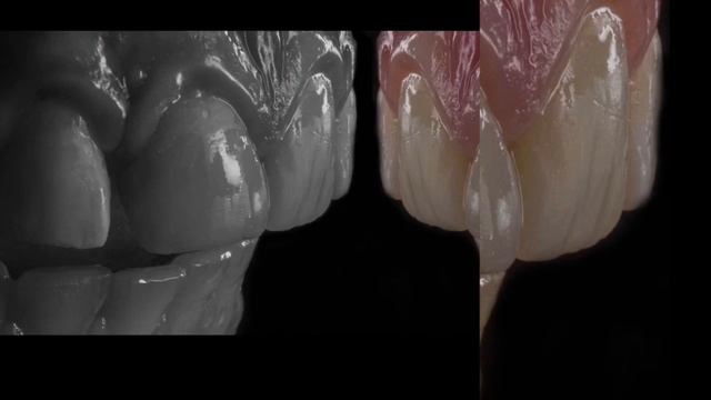 Композитная реставрация , постановка пломбы , пломба на зуб , лечение зубов , лечение кариеса смотреть онлайн