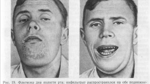 Флегмона и все о ней.