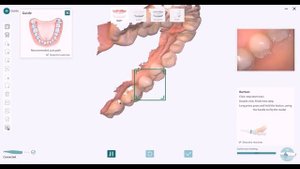 BLZ Dental Intraoral Scanner INO100 Fast Scanning Experience