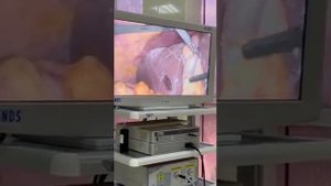 Лапароскопическое удаление желчного пузыря