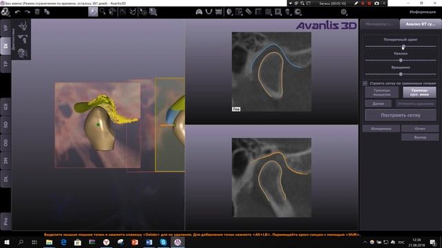 Диагностика  анализ ВНЧС. Обучающее видео от Avantis3D смотреть онлайн