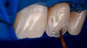 Виниры они как ногти, бери и клей. Стоматологический блог.