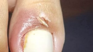 OVERGROWN INFECTED INGROWN TOENAIL REMOVAL (PODOLOGIA EM UNHA ENCRAVADA)